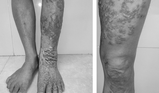 Nhiễm loại nấm da 'bị lãng quên', chân nữ bệnh nhân sần sùi, to như chân voi