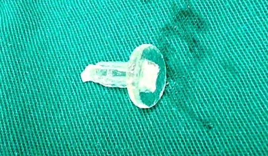 Bé trai 11 tuổi suýt chết vì thói quen ngậm bút bi