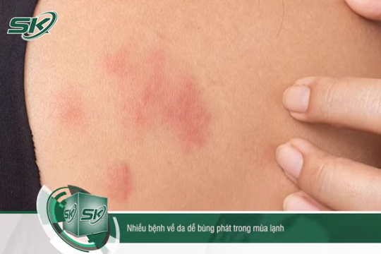 Những sai lầm gây bùng phát bệnh về da trong mùa lạnh