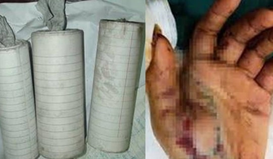 Chấn thương sọ não do tự chế pháo nổ