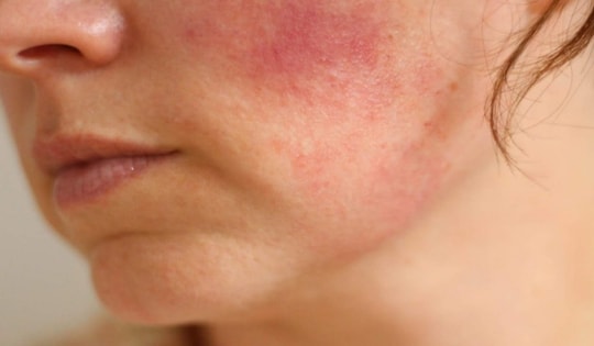 Bị viêm da cơ địa nên tránh những thực phẩm này để bệnh không 'vượng lên' khi thời tiết lạnh khô