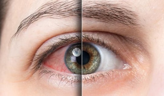 Nhận biết và điều trị khô mắt tránh suy giảm thị lực