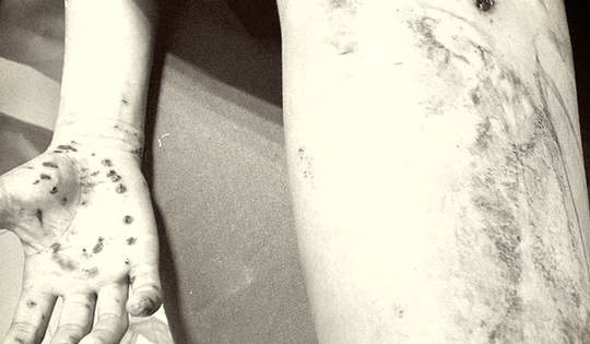 Thiếu niên 15 tuổi bị đa chấn thương do điện thoại phát nổ khi vừa dùng vừa sạc