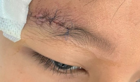 Nghịch súng hơi, bé trai bị viên đạn chì găm sâu vào xương sọ