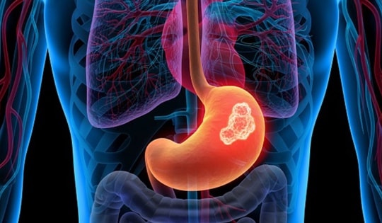 Dấu hiệu cảnh báo ung thư dạ dày cần đi khám ngay