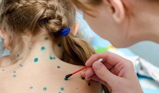 Ca mắc thuỷ đậu ở Hà Nội tăng cao, tuân thủ 5 khuyến cáo của Bộ Y tế để phòng tránh