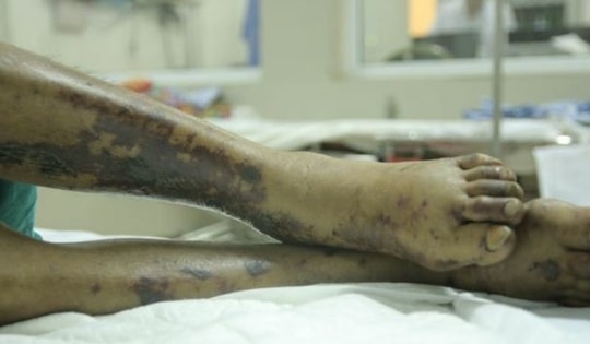 Nhận biết và đề phòng bệnh liên cầu lợn ở người