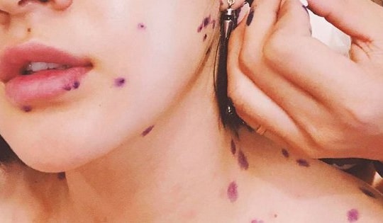 Biến chứng nguy hiểm của thủy đậu