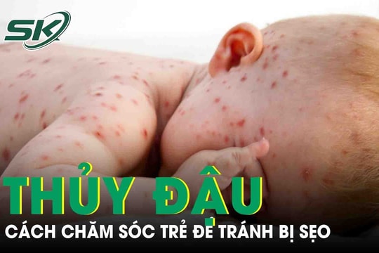 Cách chăm sóc trẻ đúng khi mắc thủy đậu để tránh bị sẹo