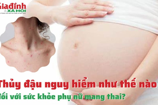 Thủy đậu nguy hiểm như thế nào đối với sức khỏe phụ nữ mang thai?