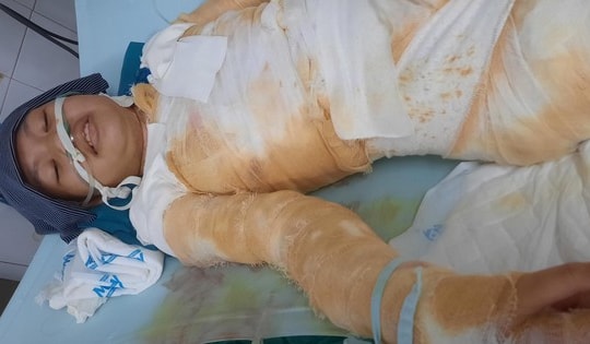 Bé gái bị bỏng nặng và nam thanh niên suy kiệt đã qua đời