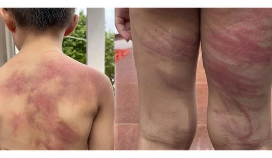 Bé trai 5 tuổi bị cha ruột đánh tàn bạo