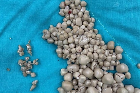 Cô gái có hơn 300 viên sỏi thận vì không uống nước nhiều năm