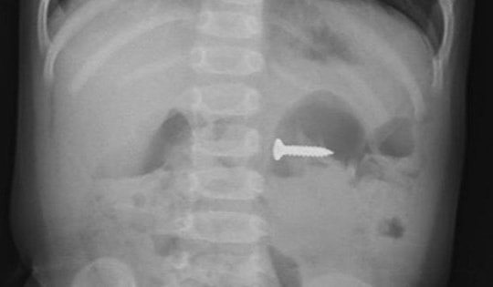 Bé 2 tuổi nuốt đinh vít sắc nhọn khi sang chơi nhà hàng xóm