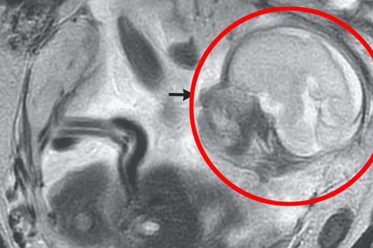 Thai nhi phát triển khỏe mạnh trong ruột mẹ