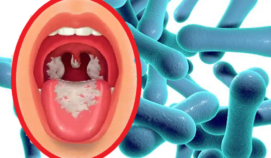 Bệnh bạch hầu có gì khác với bệnh viêm họng, viêm amidan?