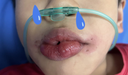 Mẹ nhét đũa ngang miệng khi con lên cơn co giật, bác sĩ nói gì?