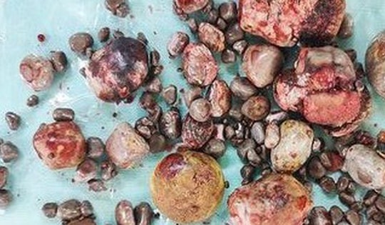 Lấy ra hơn 100 viên sỏi thận cho một bệnh nhân