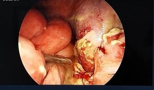 Cảnh báo tình trạng viêm ruột thừa đến muộn ở trẻ em