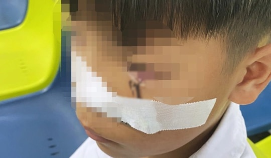 Cấp cứu bé trai 11 tuổi bị lưỡi câu sắc nhọn móc vào mắt khi đùa giỡn