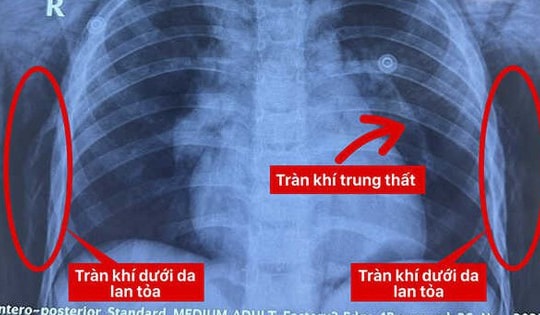 Chơi xe điện 3 bánh, bé 6 tuổi ngã vỡ khí quản, nguy kịch tính mạng