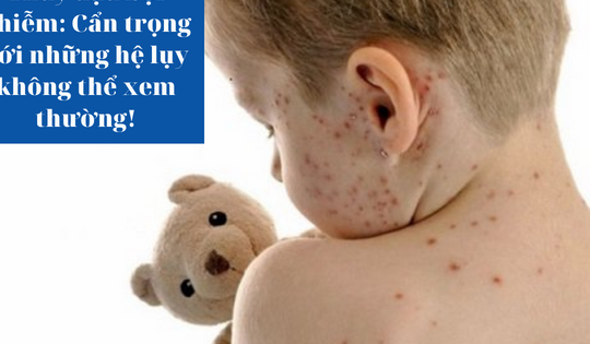 Thủy đậu bội nhiễm: Cẩn trọng và không nên xem thường!