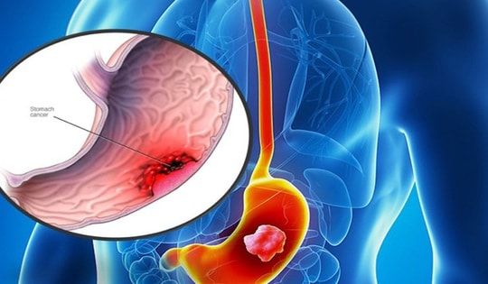 Thanh niên 22 tuổi bất ngờ phát hiện mắc ung thư dạ dày, bác sĩ chỉ rõ từ bỏ ngay 5 thói quen xấu này