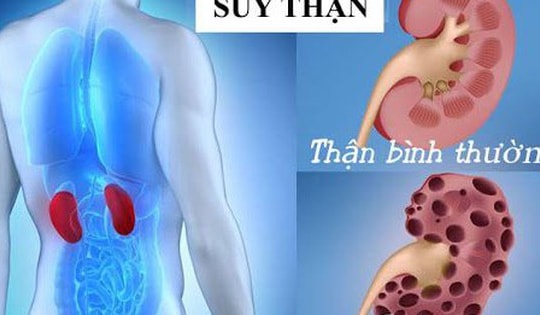 Tiết lộ 3 thói quen xấu khiến nữ Tiktoker xinh đẹp mắc suy thận độ 3, chuyên gia khuyến cáo giới trẻ nên duy trì thói quen này để phòng bệnh!