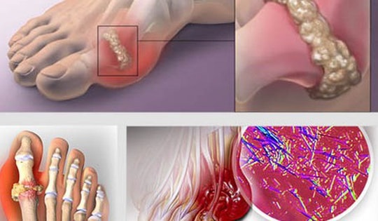 Dấu hiệu nhận biết các giai đoạn và mức độ nguy hiểm của bệnh gout
