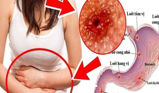 Cả 3 người trong một gia đình đều mắc ung thư dạ dày, bác sĩ chỉ rõ thủ phạm trong bữa ăn hàng ngày