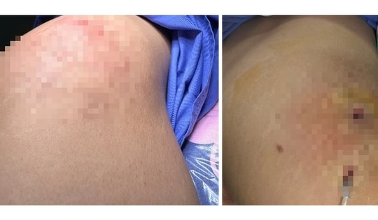 Người phụ nữ 31 tuổi bị áp xe mông sau tiêm filler làm đẹp ở spa