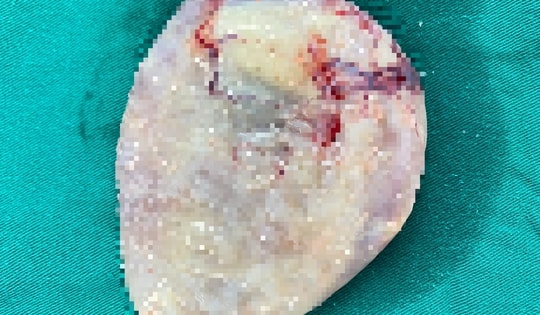 Hay ăn rau sống, gỏi cá người đàn ông nhiễm ấu trùng sán dây chó ký sinh tại phổi