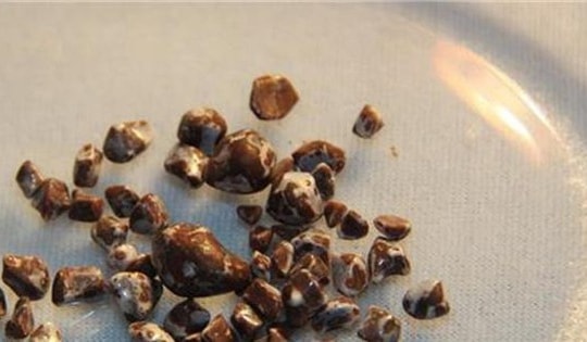 4 thói xấu khiến sỏi thận dễ tích tụ, đặc biệt người trẻ càng thường quen làm