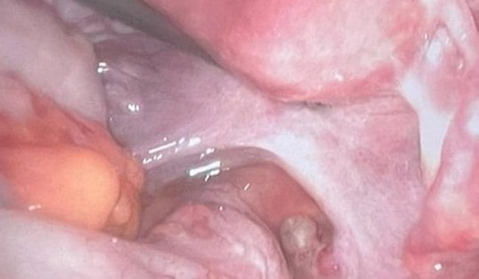 Người phụ nữ 48 tuổi ở Hà Nội chửa ngoài tử cung vô cùng hiếm gặp