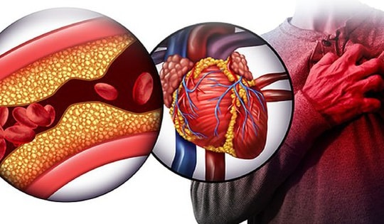 Bệnh mỡ máu cao tàn phá cơ thể như thế nào? Đây là cách phòng ngừa bệnh hiệu quả