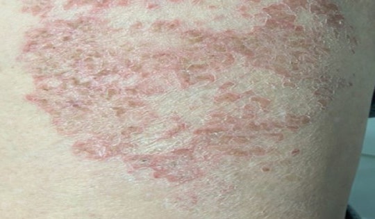 Người đàn ông ngứa dữ dội suốt 6 tháng không dứt, đi khám mới biết do thói quen nhiều người hay gặp