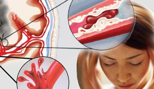 Nữ sinh 15 tuổi bất ngờ đột quỵ ở trường học, trước khi đột quỵ có biểu hiện này!