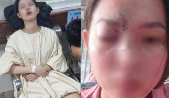 Thiếu nữ 17 tuổi mù mắt vĩnh viễn, liệt nửa não trái sau tiêm filler nâng mũi: Đừng quên 4 điều để an toàn khi làm đẹp