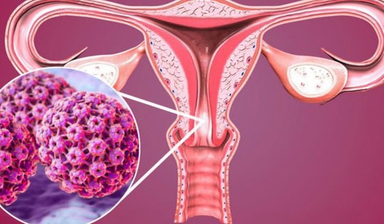 Virus HPV có thể gây những bệnh ung thư nào?