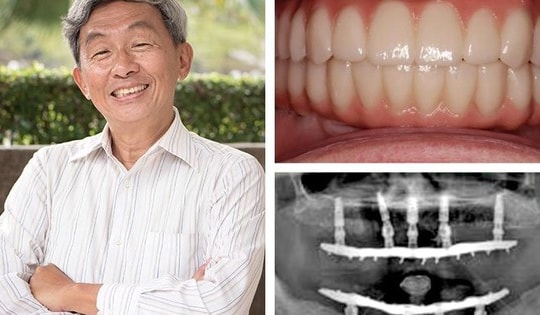 Trồng răng Implant từ tính an toàn cho mọi đối tượng
