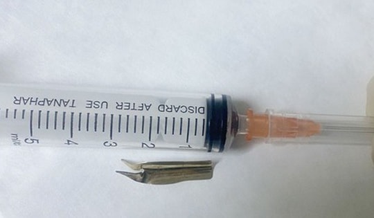 Nuốt phải ngòi bút máy, một bệnh nhi phải nhập viện khẩn cấp