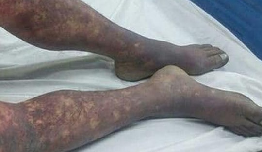 Ăn tiết canh lợn tất niên cuối năm, người đàn ông 50 tuổi tử vong