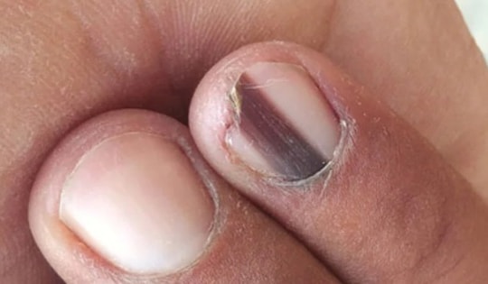 Một phụ nữ phát hiện ung thư từ vệt đen trên móng chân, người Việt cần cảnh giác với dấu hiệu này!