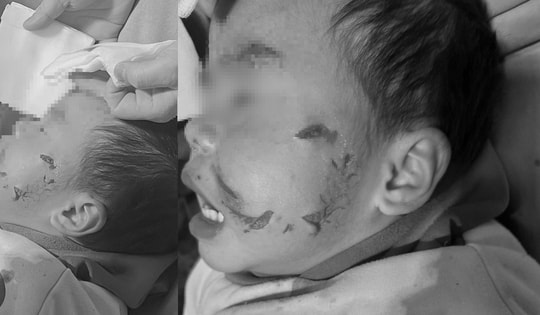 Phú Thọ: Bé trai 3 tuổi bị chó hàng xóm cắn ở vùng mặt gây tổn thương