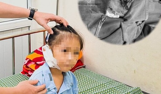 Đang chơi đùa, bé gái 6 tuổi bị đứt tai vì kính vỡ