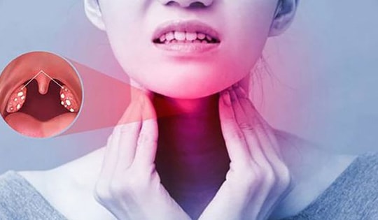 Những biến chứng của viêm họng cấp tính mùa lạnh