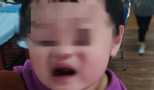 Bé 2 tuổi bị liệt mặt, méo miệng sau khi đi được bố mẹ cho đi xe máy buổi tối, bác sĩ chỉ cách bảo vệ trẻ trong mùa lạnh