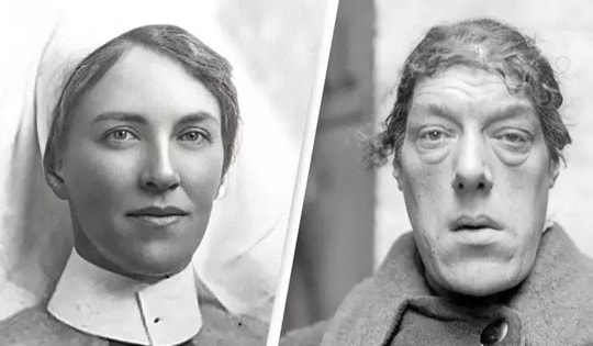 Căn bệnh biến cô gái xinh xắn thành người phụ nữ 'xấu nhất thế giới'