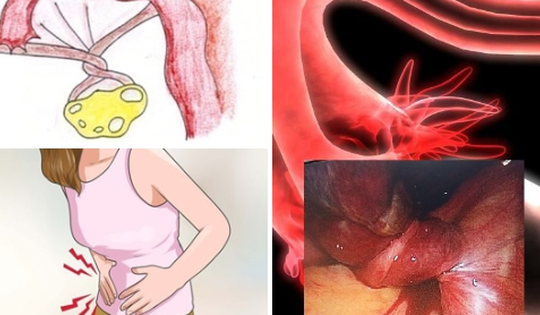 Bé gái 9 tuổi đau bụng rồi nôn ói, đi khám mới biết mắc bệnh hiểm, bác sĩ chỉ rõ chị em có dấu hiệu này cần khám ngay!