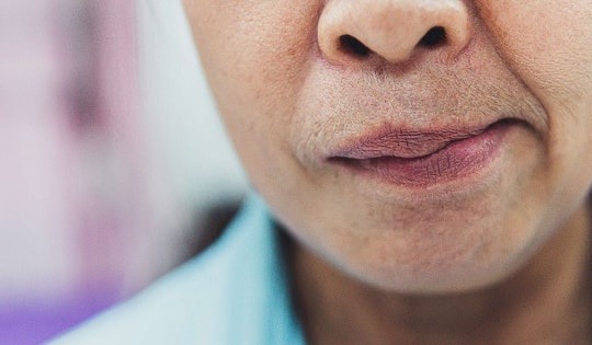 Liệt dây thần kinh số 7 có nguy hiểm không?